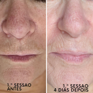 Indução Percutânea de Colagénio. Objetivos de tratamento: tratar manchar, flacidez e rugas profundas