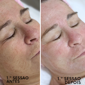 Indução Percutânea de Colagénio. Objetivos de tratamento: tratar manchar, flacidez e rugas profundas