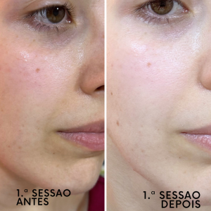 Indução Percutânea de Colagénio. Objetivos de tratamento: redução de cicatrizes de acne e melhorar aparência dos poros