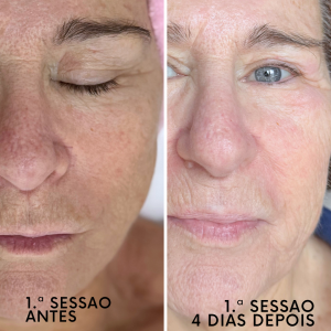 Indução Percutânea de Colagénio. Objetivos de tratamento: tratar manchar, flacidez e rugas profundas