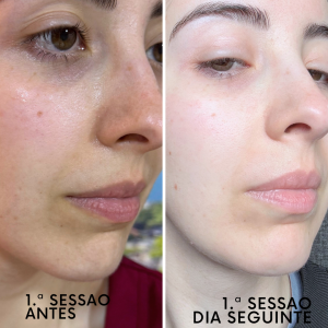 Indução Percutânea de Colagénio. Objetivos de tratamento: redução de cicatrizes de acne e melhorar aparência dos poros