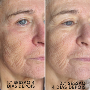 Indução Percutânea de Colagénio. Objetivos de tratamento: tratar manchas, flacidez e rugas profundas