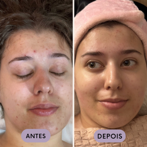 4ªsessão. Objetivos de tratamento: acne, cicatrizes e luminosidade
