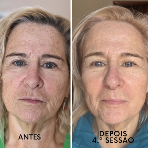 4ªsessão: Indução Percutânea de Colagénio