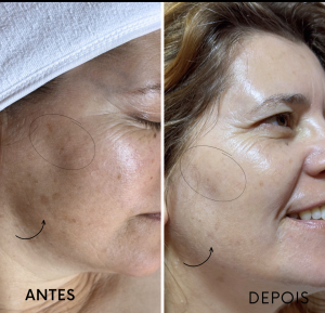 Objetivos de tratamento: atenuação de manchas
